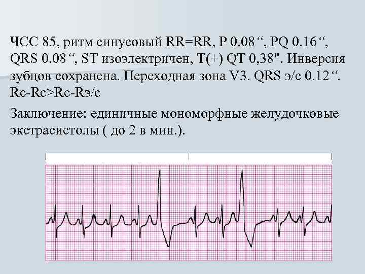 ЧСС 85, ритм синусовый RR=RR, Р 0. 08“, PQ 0. 16“, QRS 0. 08“,