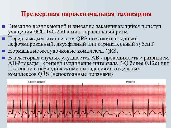 Предсердная пароксизмальная тахикардия Внезапно возникающий и внезапно заканчивающийся приступ учащения ЧСС 140 -250 в
