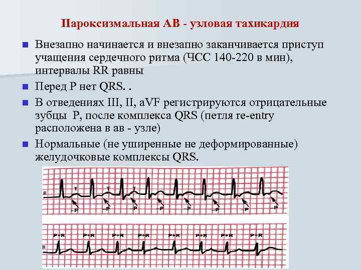 Пароксизмальная АВ - узловая тахикардия n n Внезапно начинается и внезапно заканчивается приступ учащения