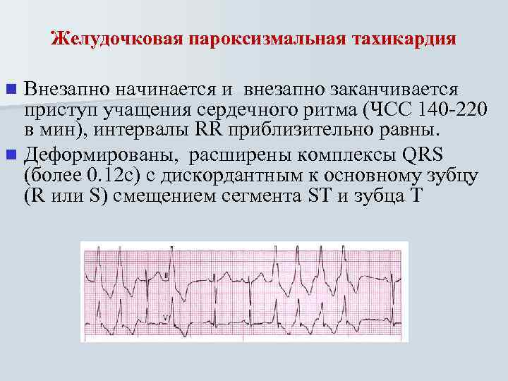 Желудочковая пароксизмальная тахикардия Внезапно начинается и внезапно заканчивается приступ учащения сердечного ритма (ЧСС 140