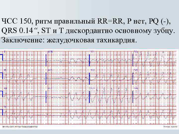 Дискордантных парах