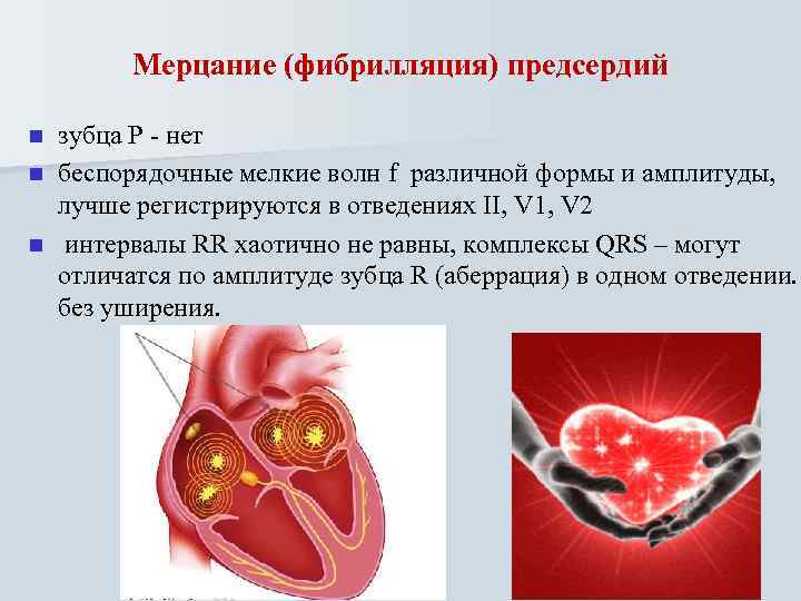Мерцание (фибрилляция) предсердий зубца Р - нет n беспорядочные мелкие волн f различной формы