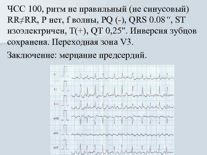 ЧСС 100, ритм не правильный (не синусовый) RR≠RR, Р нет, f волны, PQ (-),