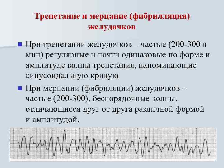 Трепетание и мерцание (фибрилляция) желудочков При трепетании желудочков – частые (200 -300 в мин)