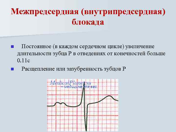 Межпредсердная (внутрипредсердная) блокада Постоянное (в каждом сердечном цикле) увеличение длительности зубца Р в отведениях