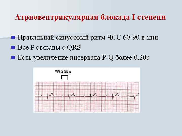 Атриовентрикулярная блокада I степени Правильнай синусовый ритм ЧСС 60 -90 в мин n Все