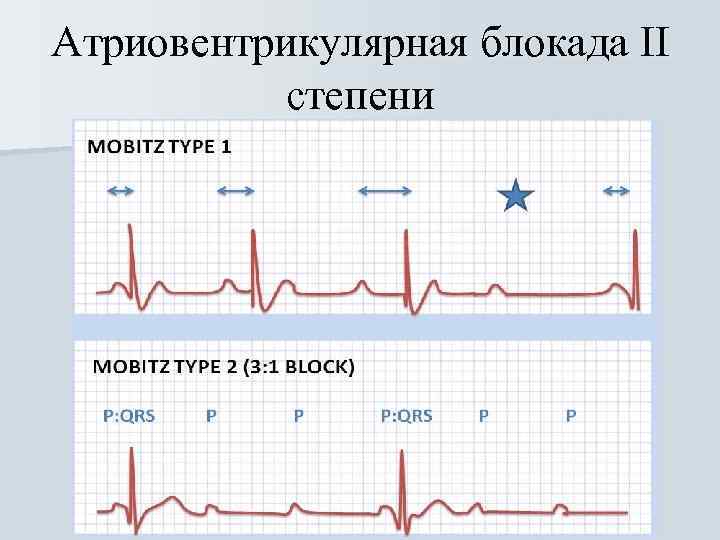 Атриовентрикулярная блокада II степени 
