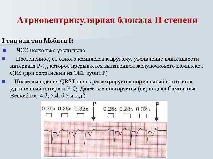 Атриовентрикулярная блокада II степени I тип или тип Мобитц I: ЧСС несколько уменьшена n