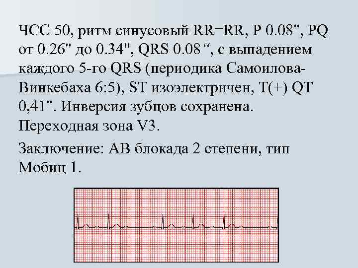 ЧСС 50, ритм синусовый RR=RR, Р 0. 08