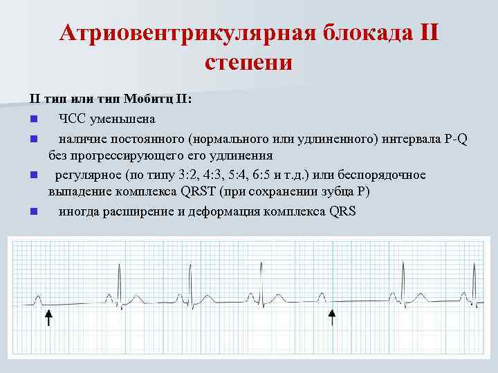 Атриовентрикулярная блокада II степени II тип или тип Мобитц II: n ЧСС уменьшена n