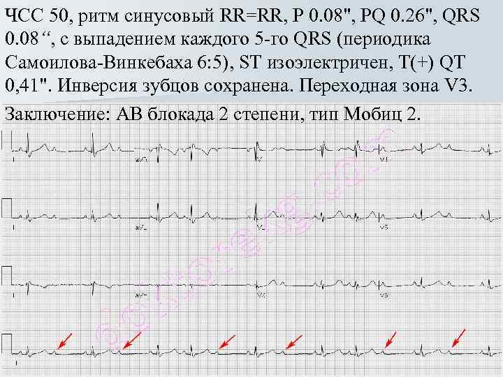 ЧСС 50, ритм синусовый RR=RR, Р 0. 08