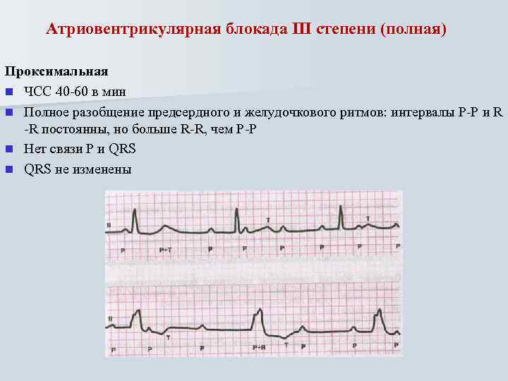 Атриовентрикулярная блокада III степени (полная) Проксимальная n ЧСС 40 -60 в мин n Полное
