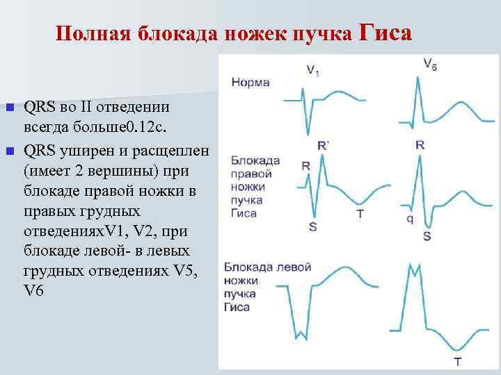 Полная блокада ножек пучка Гиса QRS во II отведении всегда больше 0. 12 с.