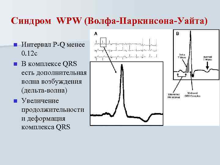 Синдром WPW (Волфа-Паркинсона-Уайта) Интервал P-Q менее 0. 12 с n В комплексе QRS есть