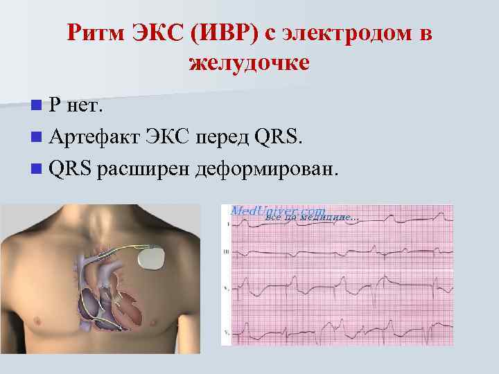 Ритм ЭКС (ИВР) с электродом в желудочке n Р нет. n Артефакт ЭКС перед