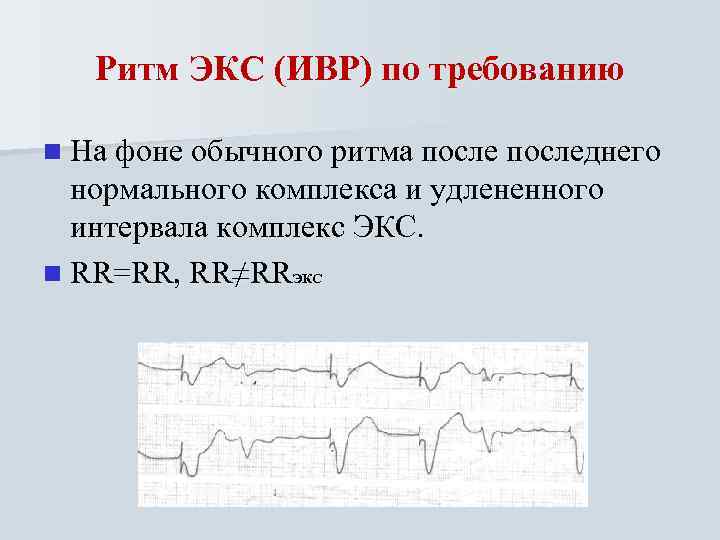 Ритм ЭКС (ИВР) по требованию n На фоне обычного ритма последнего нормального комплекса и