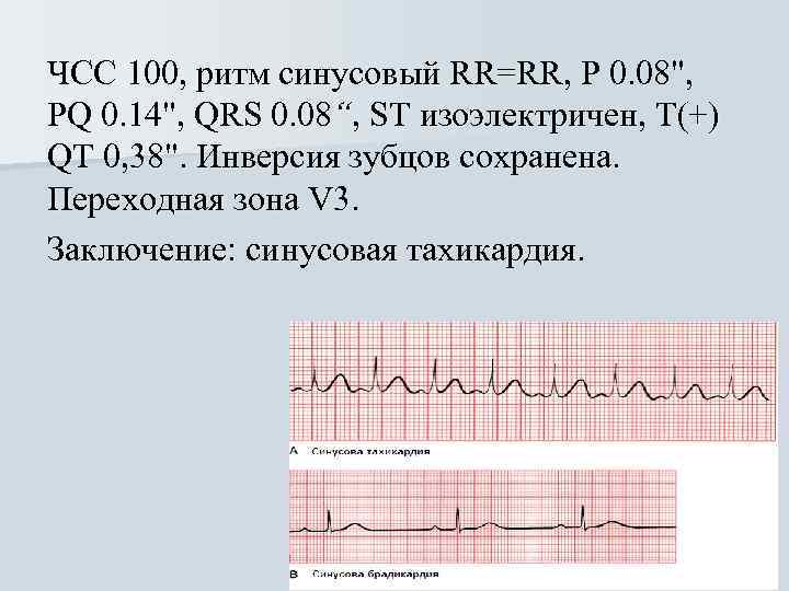 ЧСС 100, ритм синусовый RR=RR, Р 0. 08