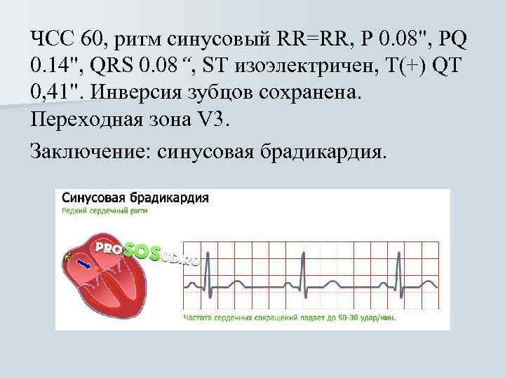 ЧСС 60, ритм синусовый RR=RR, Р 0. 08