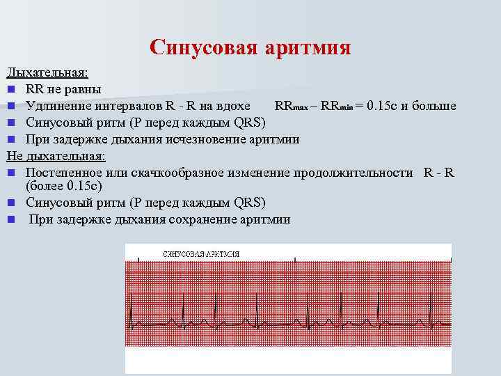 Синусовая аритмия Дыхательная: n RR не равны n Удлинение интервалов R - R на