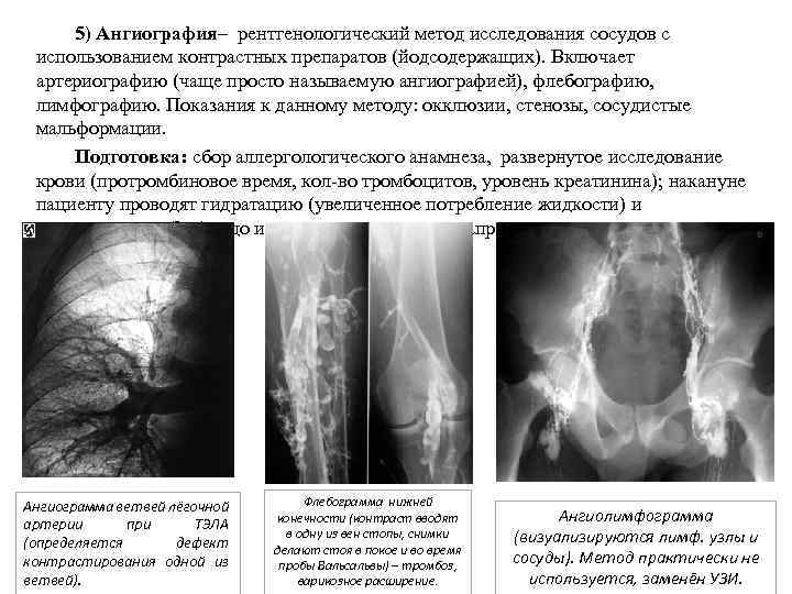 5) Ангиография– рентгенологический метод исследования сосудов с использованием контрастных препаратов (йодсодержащих). Включает артериографию (чаще