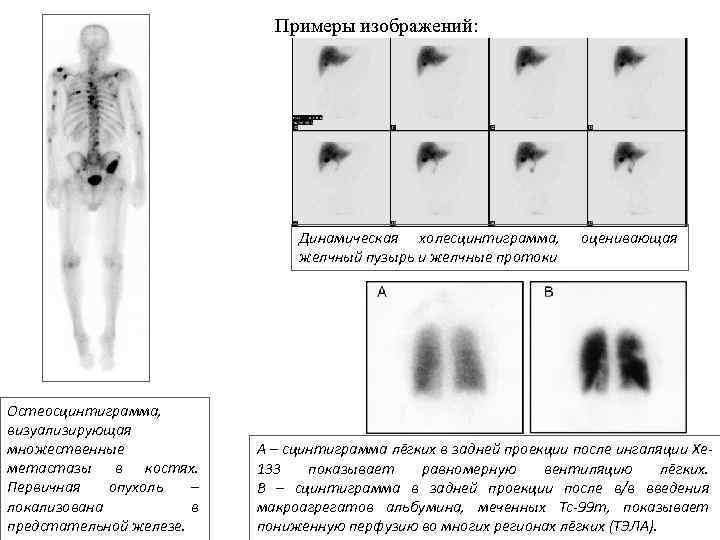 Примеры изображений: Динамическая холесцинтиграмма, желчный пузырь и желчные протоки Остеосцинтиграмма, визуализирующая множественные метастазы в