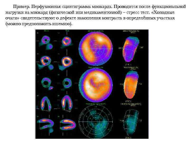 Пример. Перфузионная сцинтиграмма миокарда. Проводится после функциональной нагрузки на миокард (физической или медикаментозной) –