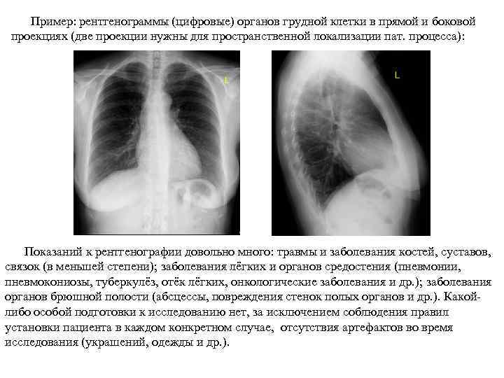 Пример: рентгенограммы (цифровые) органов грудной клетки в прямой и боковой проекциях (две проекции нужны