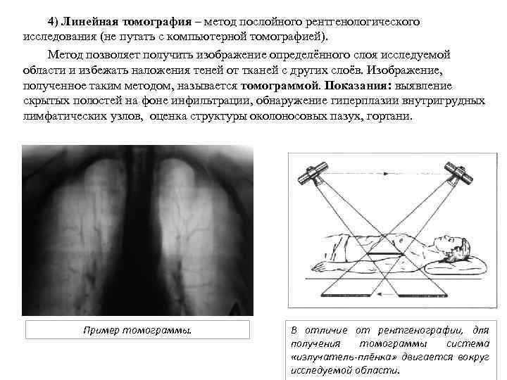 4) Линейная томография – метод послойного рентгенологического исследования (не путать с компьютерной томографией). Метод