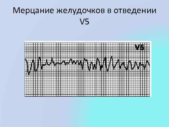 Мерцание трепетание. Трепетание и мерцание желудочков. Механизм мерцания желудочков. Трепетание и мерцание желудочков тактика ведения. Мерцание желудочков помощь.