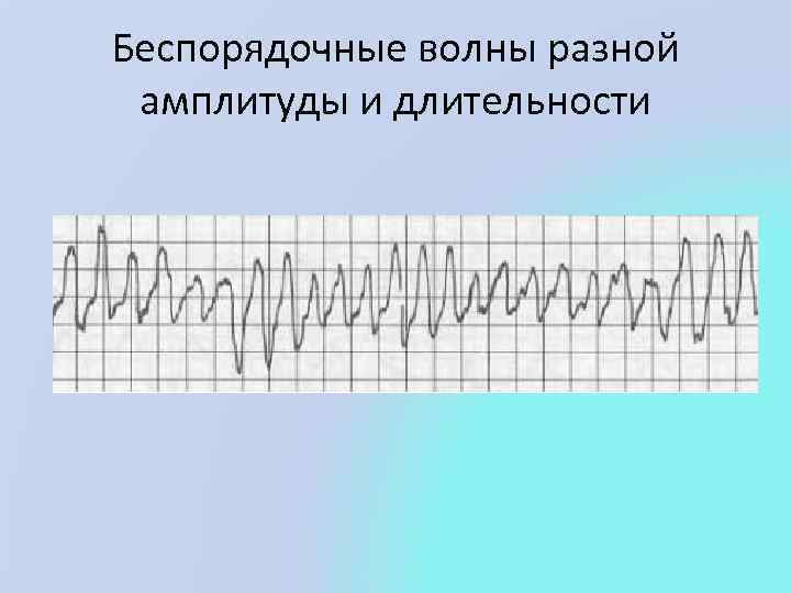 Беспорядочные волны разной амплитуды и длительности 