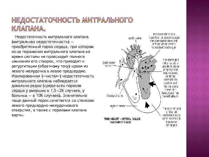 Ревматический порок митрального клапана