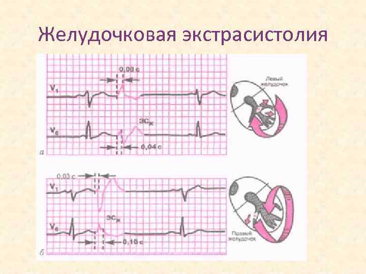 Желудочковая экстрасистолия на экг фото