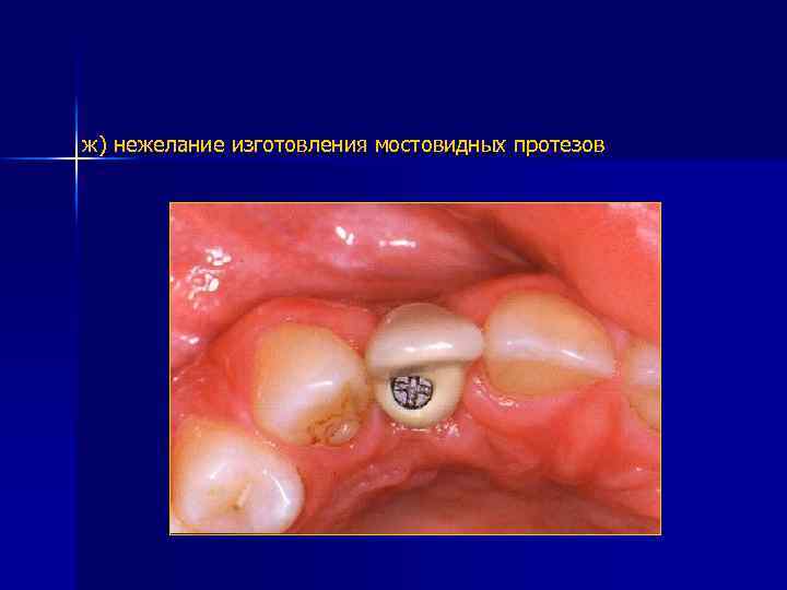 ж) нежелание изготовления мостовидных протезов 