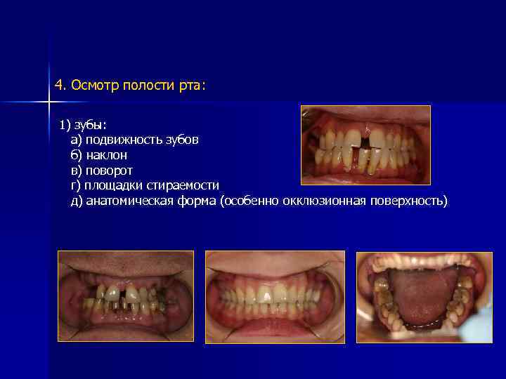 4. Осмотр полости рта: 1) зубы: а) подвижность зубов б) наклон в) поворот г)