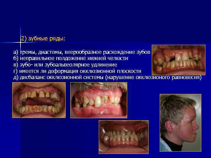 2) зубные ряды: а) тремы, диастемы, веерообразное расхождение зубов б) неправильное полдожение нижней челюсти