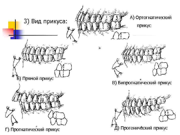 Прямая окклюзия. Ортогнатический прикус сбоку. Типы прикусов зубов у человека. Ортогнатический, прогенический, прямой прикус. Ортогнатический прикус постановка зубов.