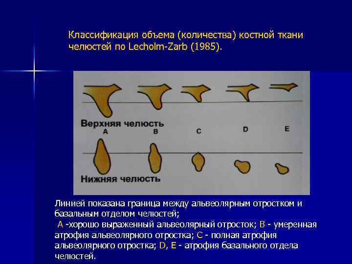 Классификация объема (количества) костной ткани челюстей по Lecholm-Zarb (1985). Линией показана граница между альвеолярным