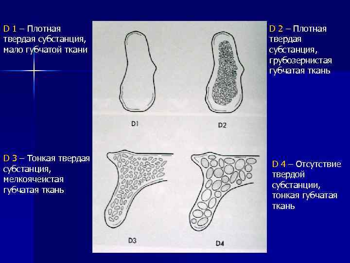 D 1 – Плотная твердая субстанция, мало губчатой ткани D 3 – Тонкая твердая