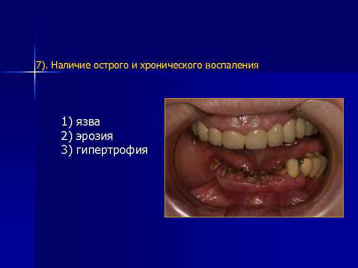 7). Наличие острого и хронического воспаления 1) язва 2) эрозия 3) гипертрофия 