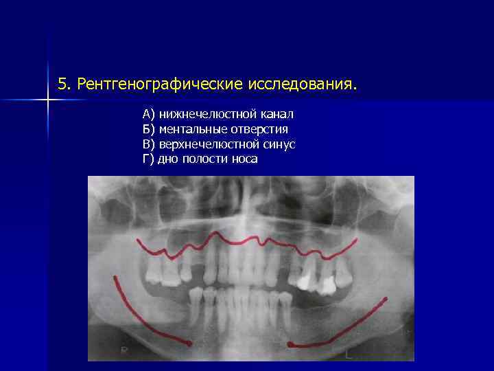 5. Рентгенографические исследования. А) нижнечелюстной канал Б) ментальные отверстия В) верхнечелюстной синус Г) дно