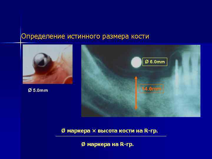 Определение истинного размера кости Ø 6. 0 mm 14. 0 mm Ø 5. 0