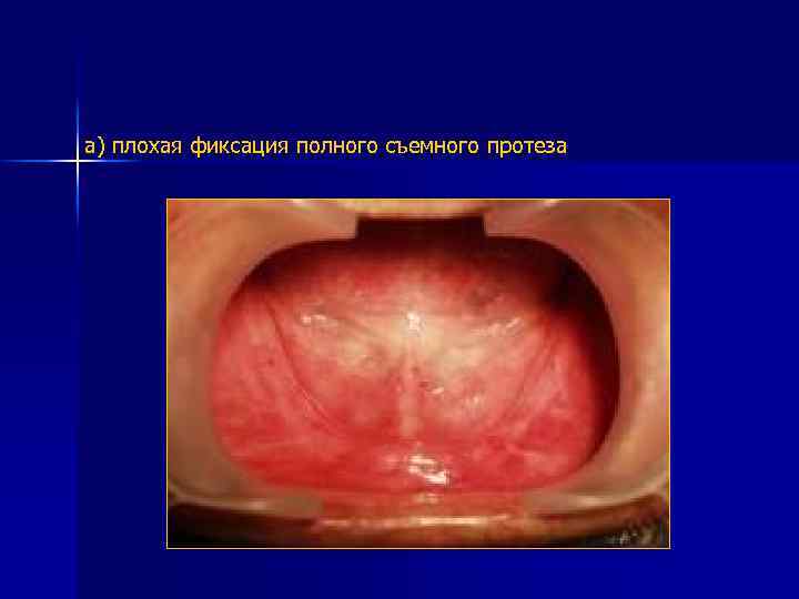 а) плохая фиксация полного съемного протеза 