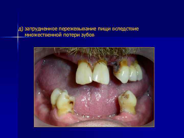 д) затрудненное пережевывание пищи вследствие множественной потери зубов 