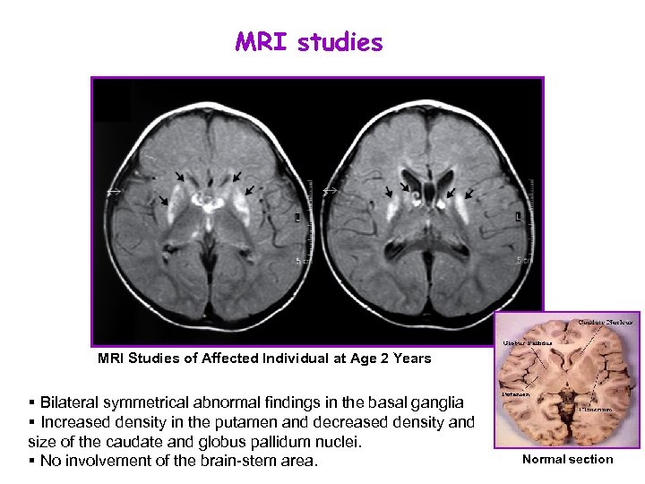 MRI studies MRI Studies of Affected Individual at Age 2 Years § Bilateral symmetrical