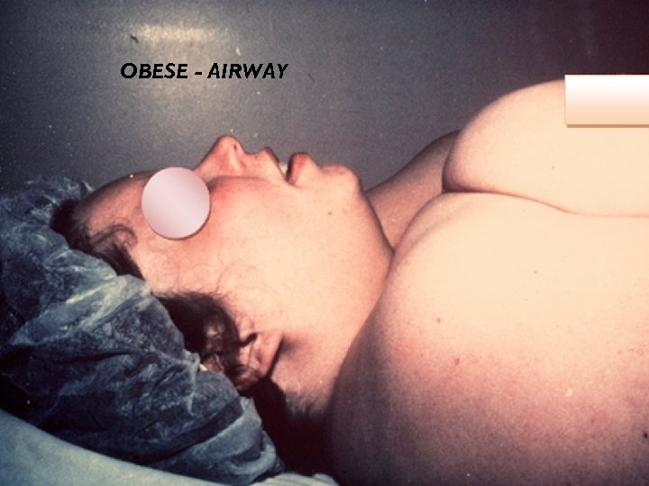 OBESE - AIRWAY 