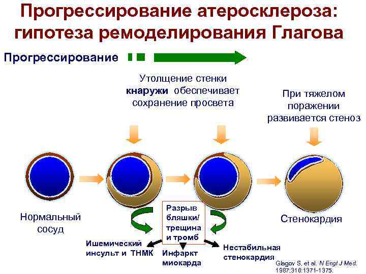 Прогрессирование атеросклероза: гипотеза ремоделирования Глагова Прогрессирование Утолщение стенки кнаружи обеспечивает сохранение просвета Нормальный сосуд