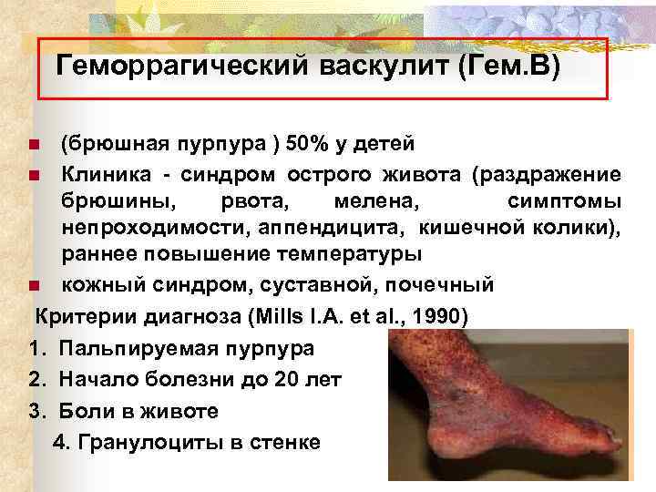 Геморрагический васкулит (Гем. В) (брюшная пурпура ) 50% у детей n Клиника - синдром