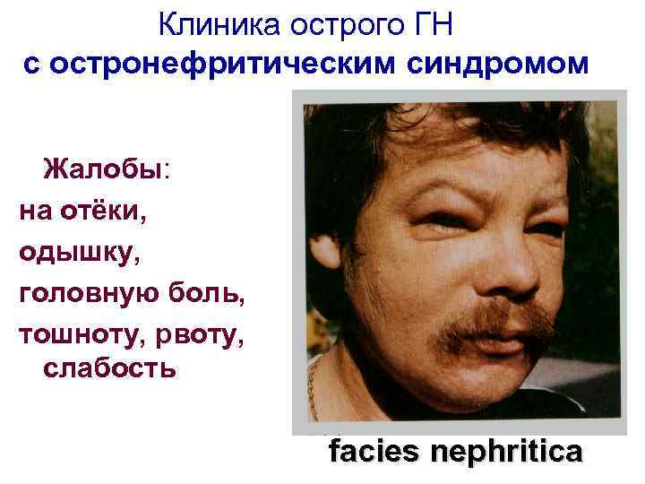Клиника острого ГН с остронефритическим синдромом Жалобы: на отёки, одышку, головную боль, тошноту, рвоту,