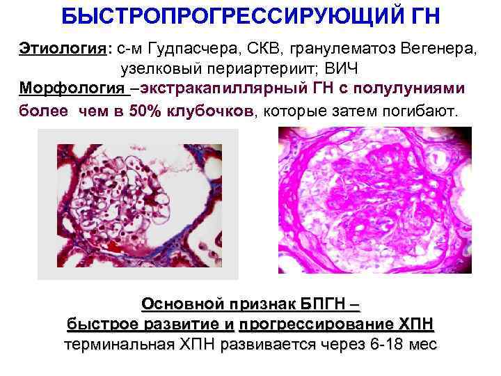 БЫСТРОПРОГРЕССИРУЮЩИЙ ГН Этиология: с-м Гудпасчера, СКВ, гранулематоз Вегенера, узелковый периартериит; ВИЧ Морфология –экстракапиллярный ГН