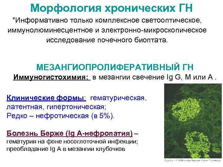 Морфология хронических ГН *Информативно только комплексное светооптическое, иммунолюминесцентное и электронно-микроскопическое исследование почечного биоптата. МЕЗАНГИОПРОЛИФЕРАТИВНЫЙ
